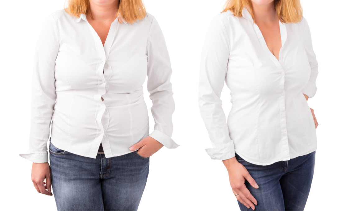 Post Bariatric Surgery